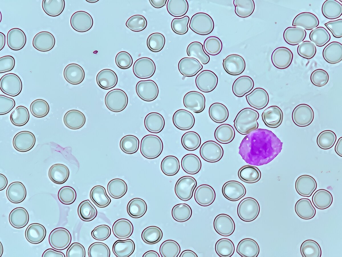 Rare Disease Detection